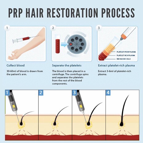 Instagram post by Dr. Justin Rome: We add #PRP and #ACell to our #ARTAS #hair procedures. These therapies can also be used as stand alone treatments.