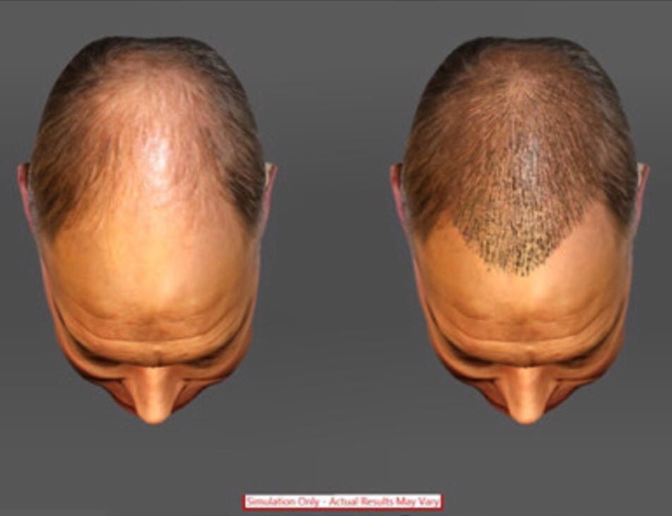 Instagram post by Dr. Justin Rome: With #ARTAS #hairstudio we can design your hair restoration and demonstrate your results. Consults are free!