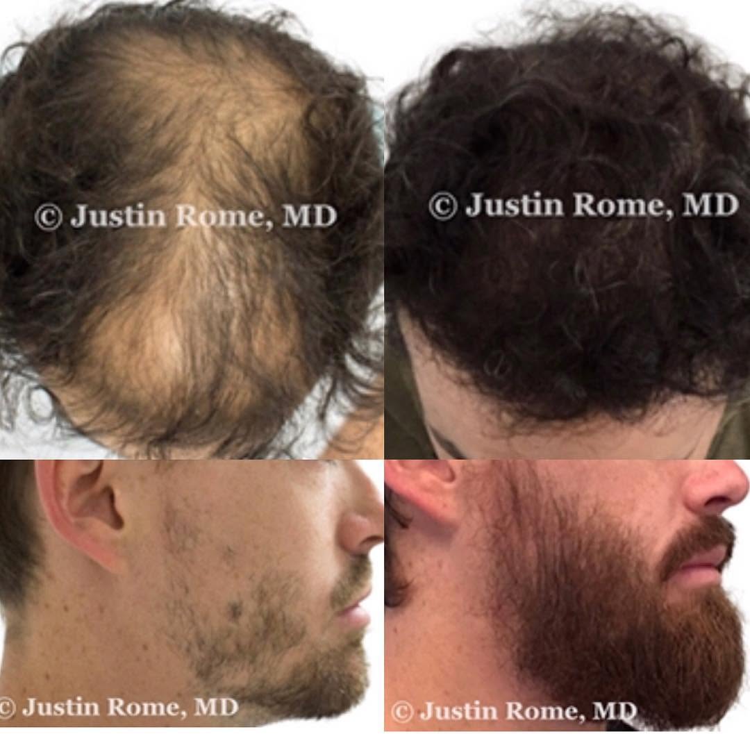 Instagram post by Dr. Justin Rome: Need more hair or more beard? We’ve got you covered! #punintended #hairrestoration #hairtransplant #robotics #ARTAS