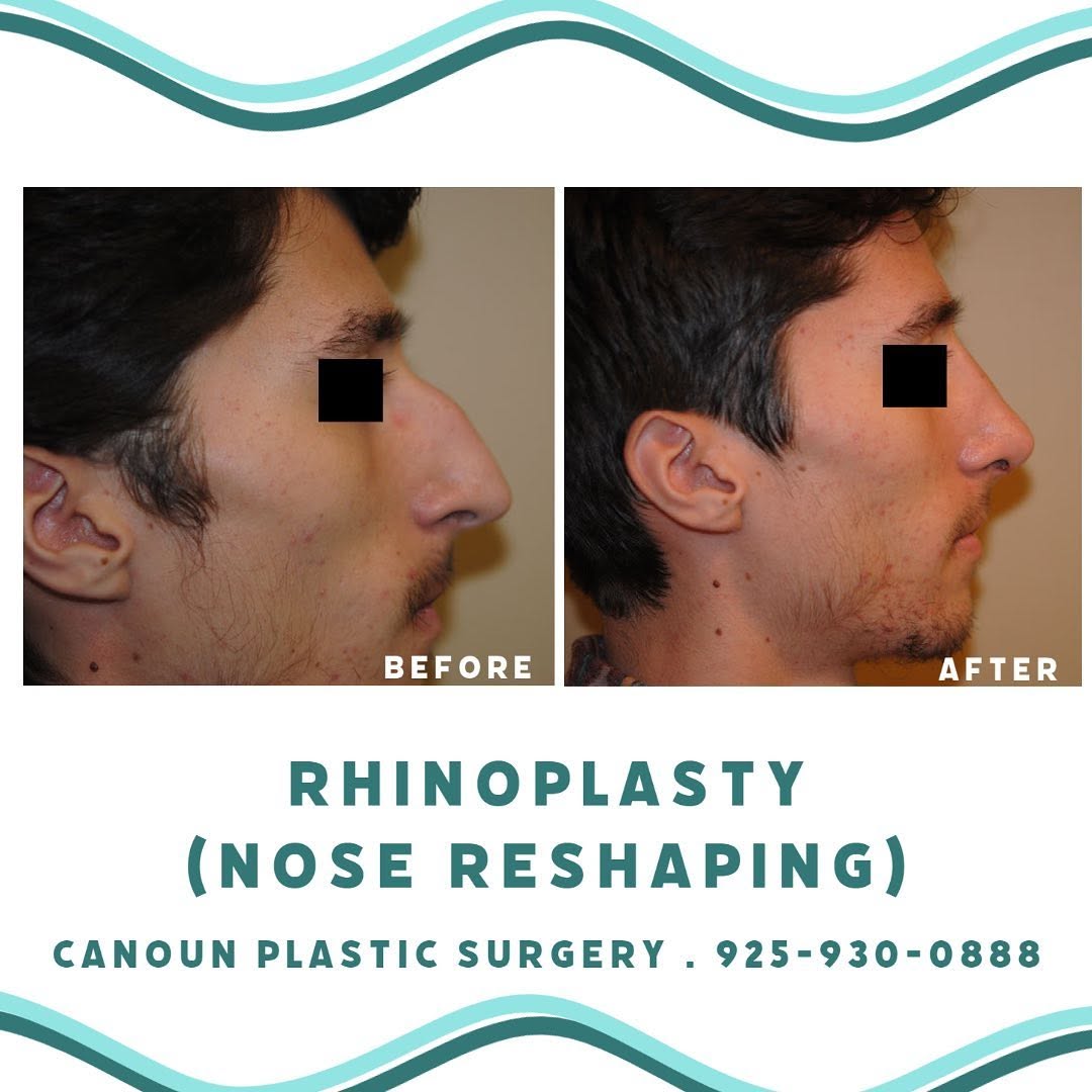 Instagram post by Dr. K. Cary Canoun: Rhinoplasty / Nose Reshaping Contact us to learn more or to schedule your consultation ➡️ 925-930-0888 #plasticsurgery #plasticsurgeon #rhin…
