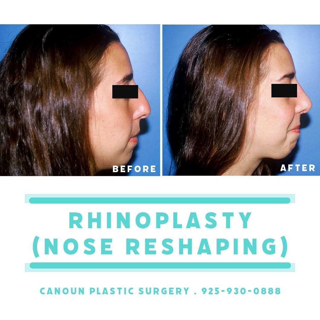 Instagram post by Dr. K. Cary Canoun: Open Rhinoplasty (pateint declined chin implant). #plasticsurgery #plasticsurgeon #rhinoplasty #openrhinoplasty #brentwoodca #walnutcreekca