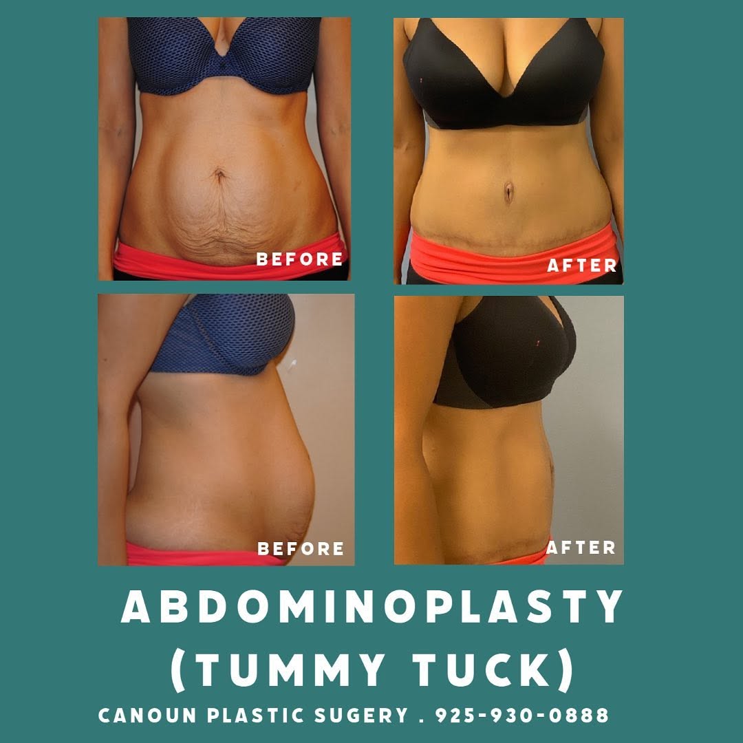 Instagram post by Dr. K. Cary Canoun: Abdominoplasty / before & after #plasticsurgery #plasticsurgeon #abdominoplasty #tummytuck #brentwoodca #walnutcreekca