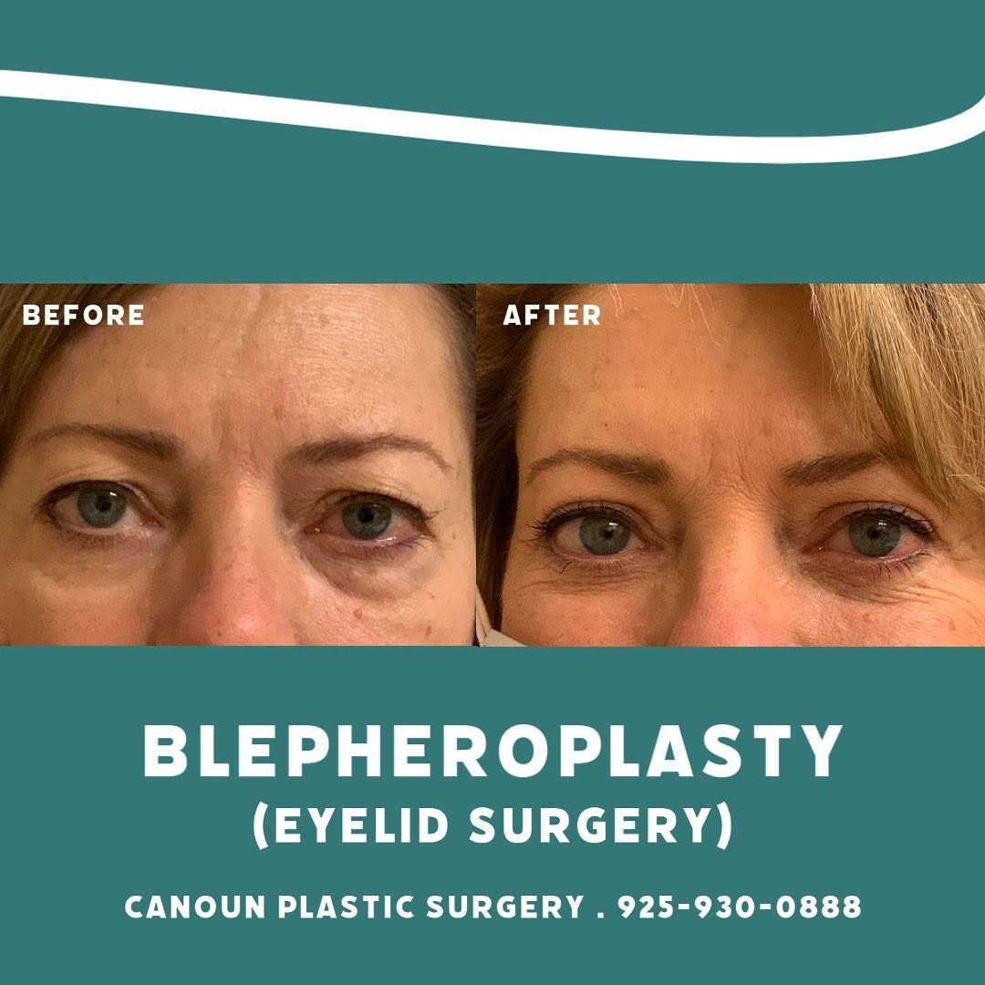 Instagram post by Dr. K. Cary Canoun: Upper and lower eyelid surgery with removal of lower eyelid fat deposits ➡️ Does this look like something you’re interested in? Reach out to…
