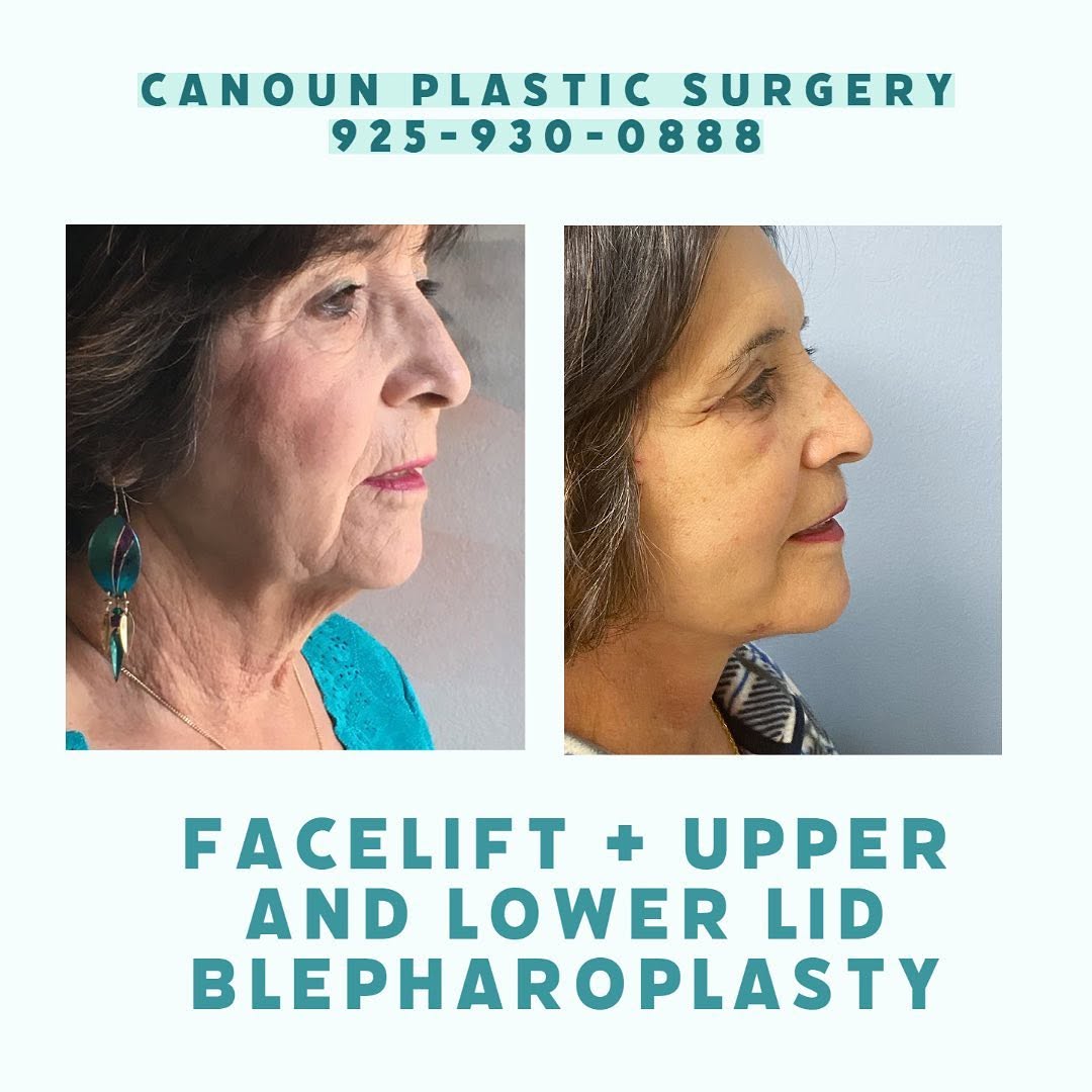 Instagram post by Dr. K. Cary Canoun: Facelift with upper and lower lid blepharoplasty / call today for details or to schedule your consultation #facelift #faceliftsurgery #plast…