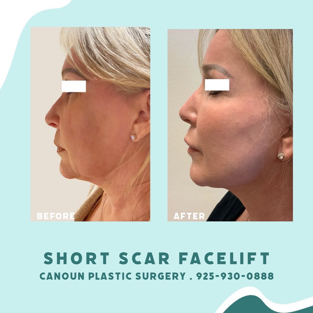 Instagram post by Dr. K. Cary Canoun: Short scar facelift ➡️ call for details or to schedule your consultation! #walnutcreekca #plasticsurgery #plasticsurgeon #beforeandafter #fa…