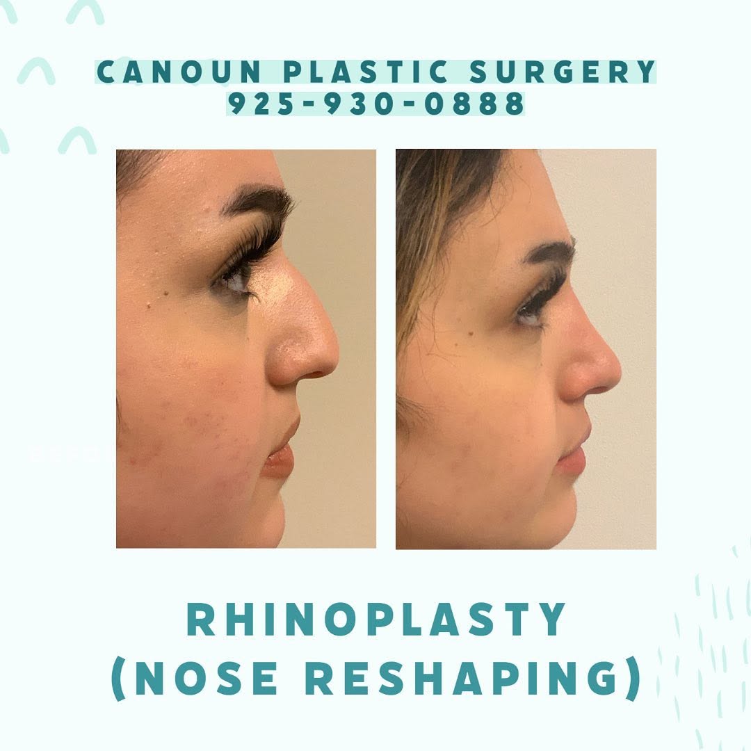 Instagram post by Dr. K. Cary Canoun: Rhinoplasty/nose reshaping ☎️925-930-0888 #rhinoplasty #plasticsurgery #surgeon #plasticsurgeon #walnutcreek