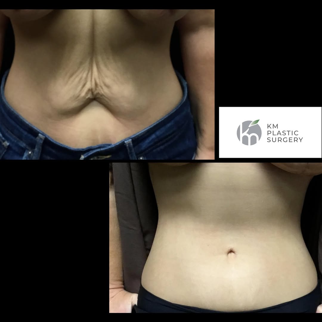 Instagram post by Dr. Kai Morimoto: Transformation in progress ✨ This incredible abdominoplasty result showcases the power of expert care and dedication to our patients' confid…