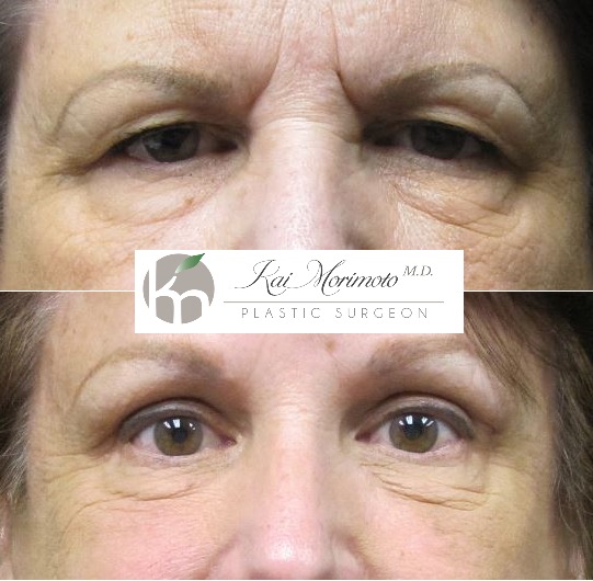 Instagram post by Dr. Kai Morimoto: Bright-eyed and refreshed! This stunning transformation showcases the power of an upper blepharoplasty and brow lift—lifting, smoothing, and…