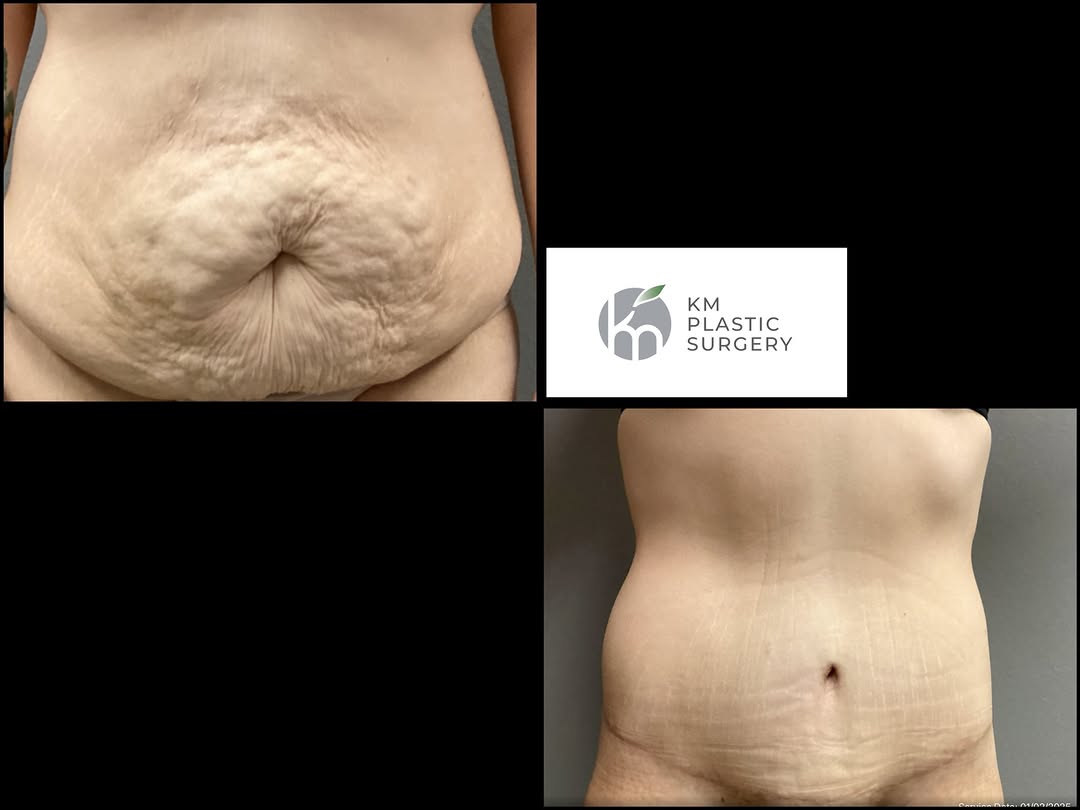 Instagram post by Dr. Kai Morimoto: Transformation Tuesday! Check out this incredible before and after of an abdominoplasty (tummy tuck) procedure! Our patient is now enjoying …