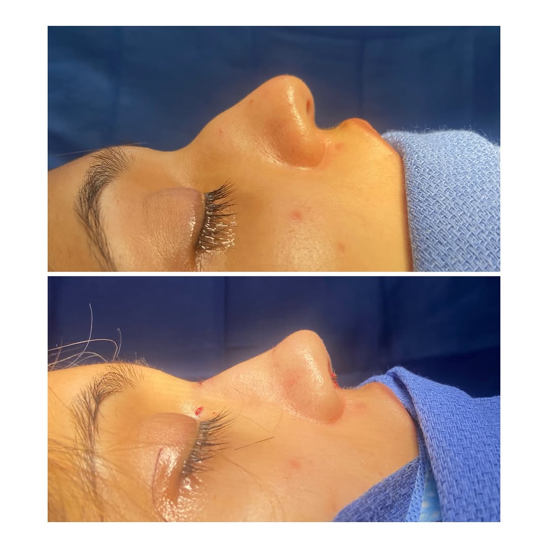 Instagram post by Dr. Kailash Narasimhan: ##Rhinoplasty in this wonderful patient to smoothen the nasal profile and lift the tip while making the tips slightly smaller. This procedur…