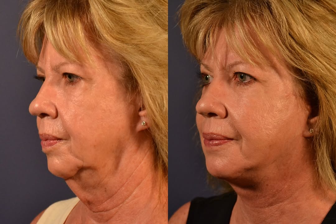 Instagram post by Dr. Kailash Narasimhan: #facelift #NeckLift to create a natural elegant appearance to the face, and provide a rejuvenation without changing the facial shaped signif…