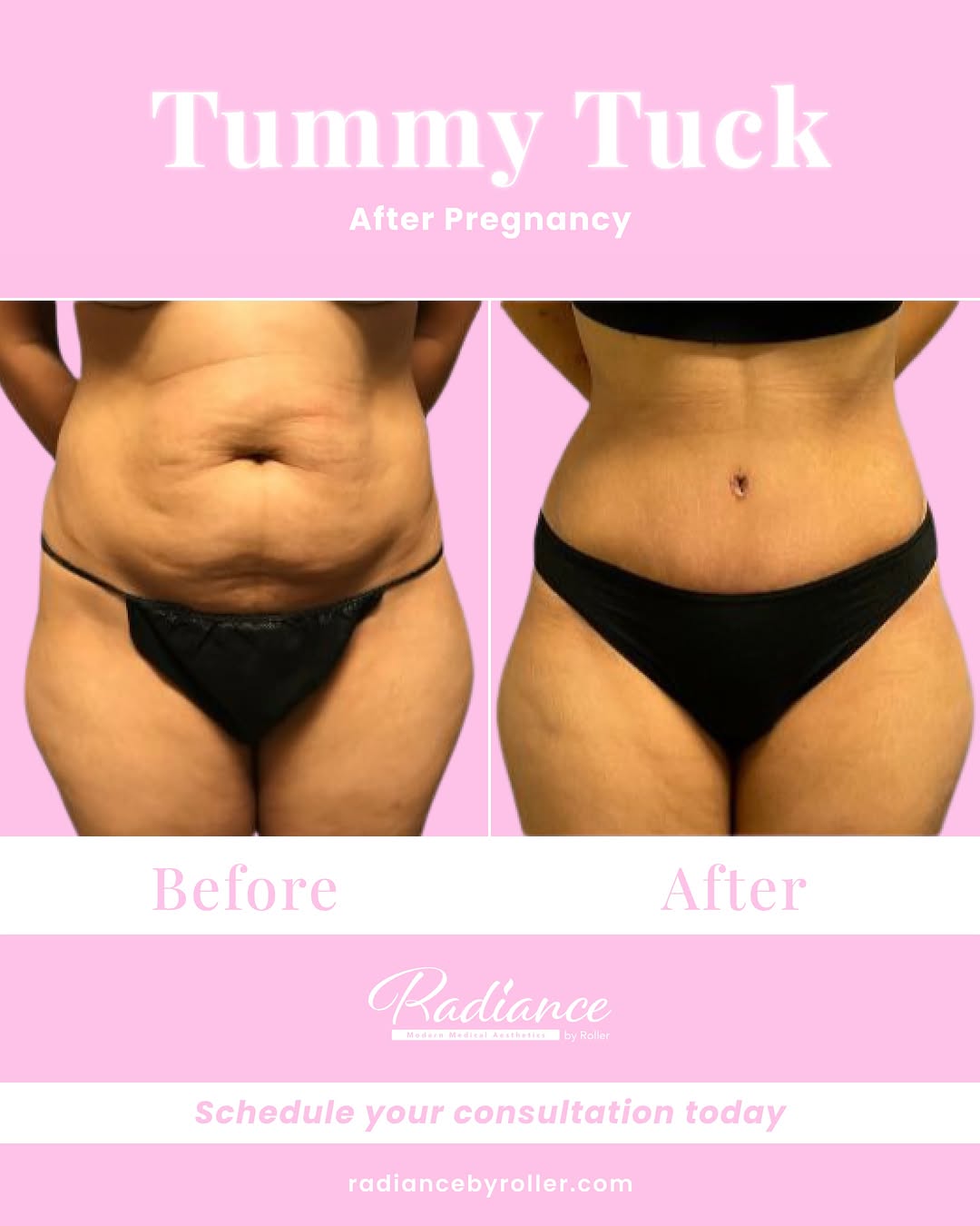 Instagram post by Dr. Kaitlyn Paine: So, what can a tummy tuck actually do? For the right candidate, a tummy tuck can address loose or excess abdominal skin and create a smoothe…