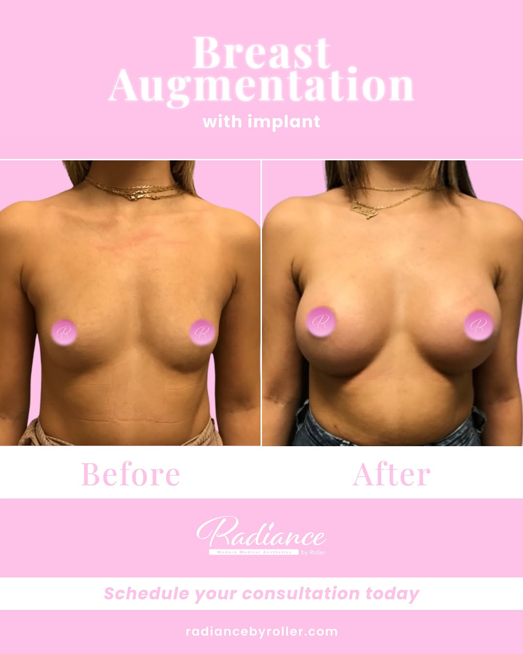 Instagram post by Dr. Kaitlyn Paine: This breast augmentation by Dr. Hedi created beautiful fullness, projection, and balance while complementing this patient’s natural proporti…