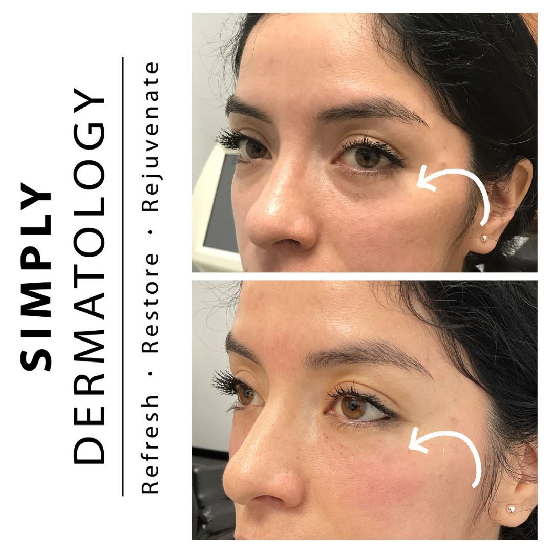 Instagram post by Dr. Kally Papantoniou: Tired-looking under-eyes, even after a full night’s sleep? Carefully placed under-eye filler can help restore lost volume and create a smoot…