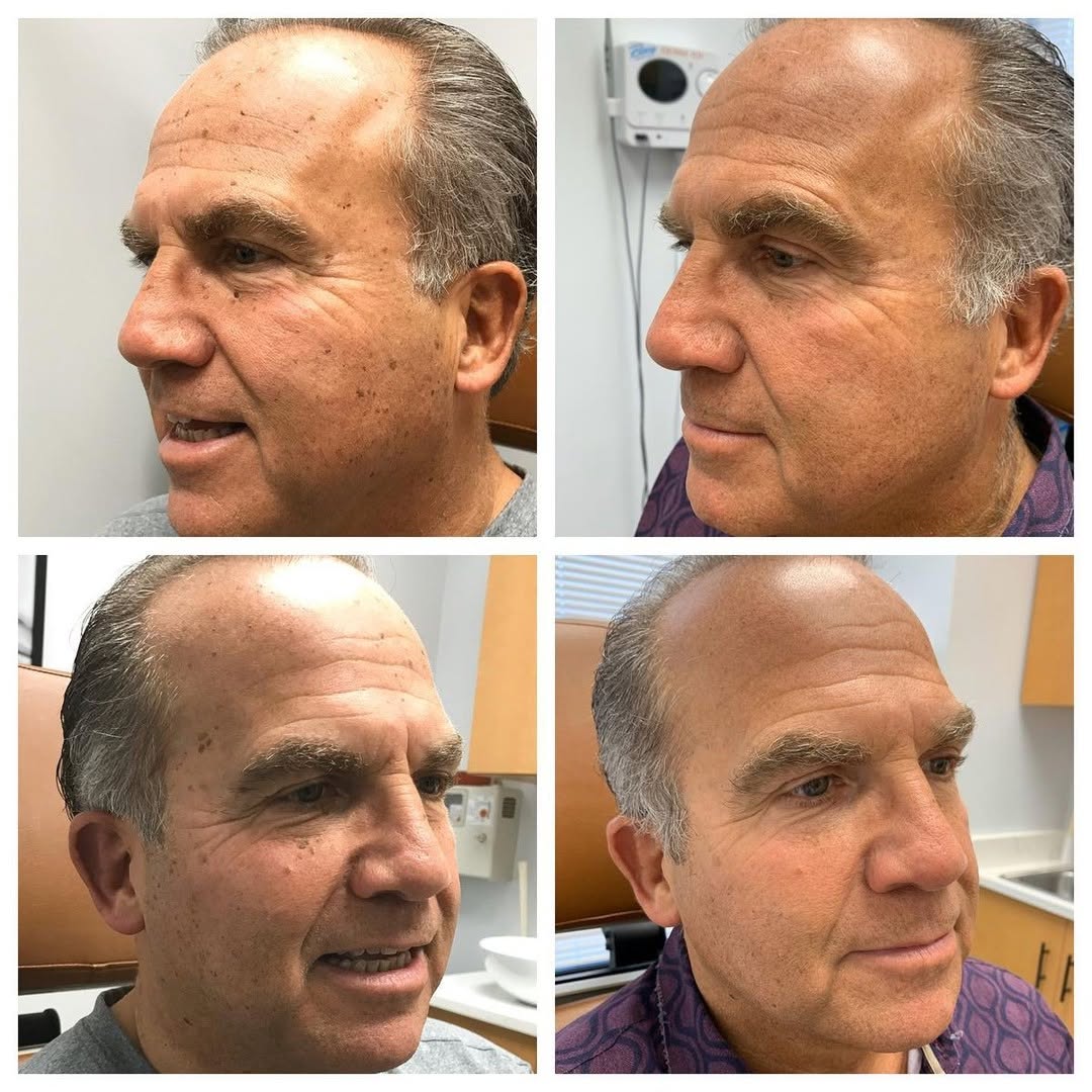 Instagram post by Dr. Kally Papantoniou: Sometimes treating just a few stubborn age spots can make the entire complexion look clearer and more refreshed ✨ At Simply Dermatology, we …