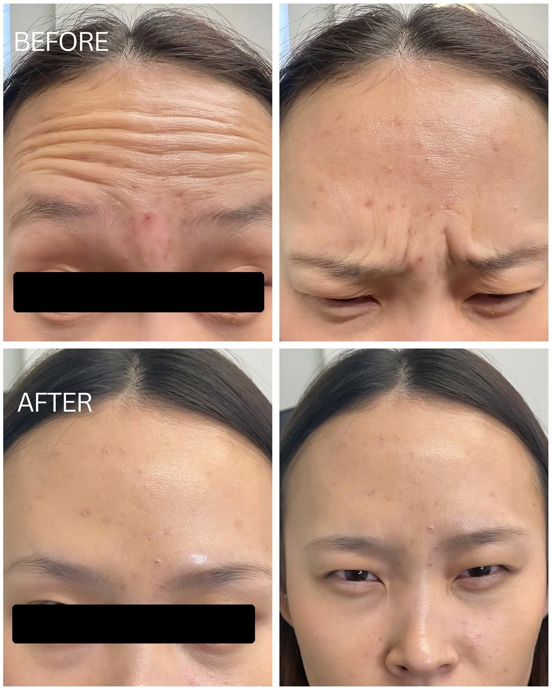 Instagram post by Dr. Kamran Hakimian: A little Botox. A softer look. ✨ Smoother forehead lines and softened frown lines—small changes that make a beautiful difference. Refresh yo…