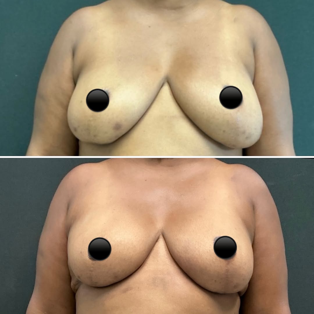 Instagram post by Dr. Kan Hwee: Breast reconstruction for risk-reducing mastectomy with one stage of surgery…leaving our patient as beautiful as we met her! 💕