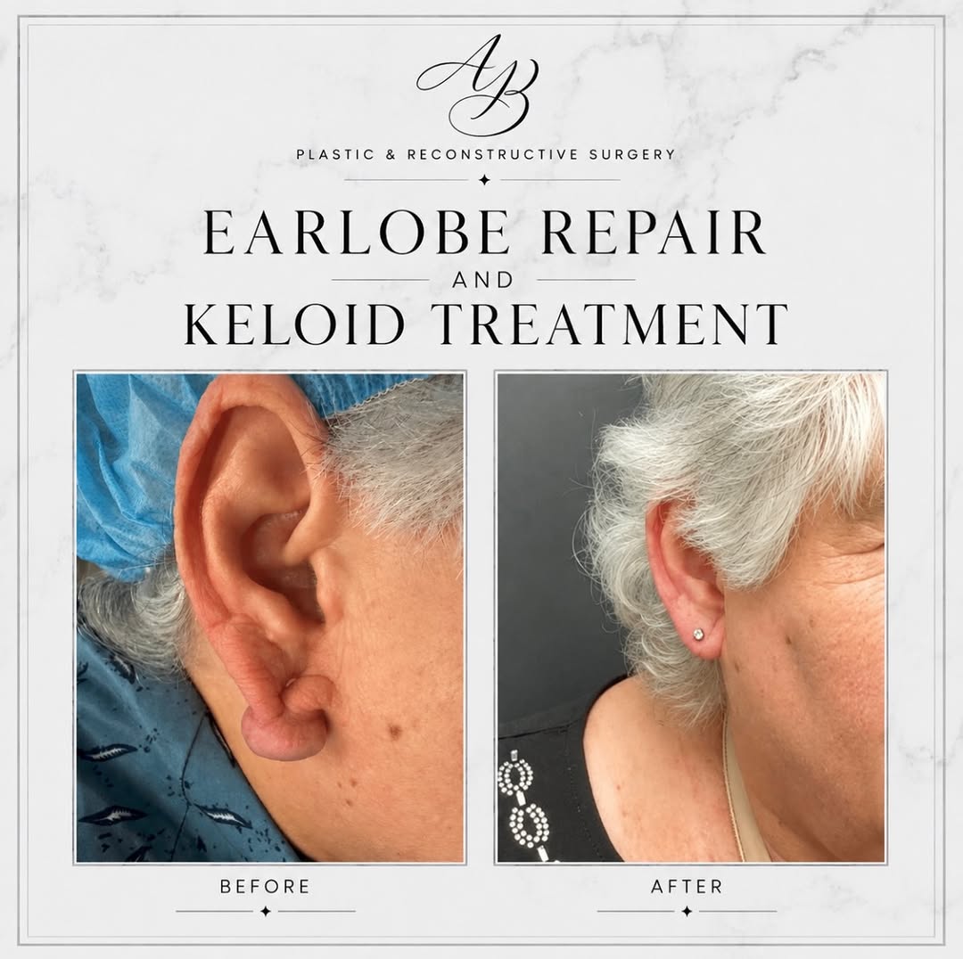 Instagram post by Dr. Kan Hwee: ✨ Small procedure. Meaningful difference. Stretched, torn, or split earlobes can happen over time from heavy earrings, trauma, or gauges. Ea…