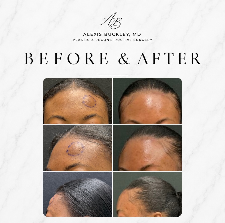 Instagram post by Dr. Kan Hwee: ✨ Beautiful results don’t have to come at the expense of a visible scar. This patient came to me with an enlarging lipoma that she wanted re…