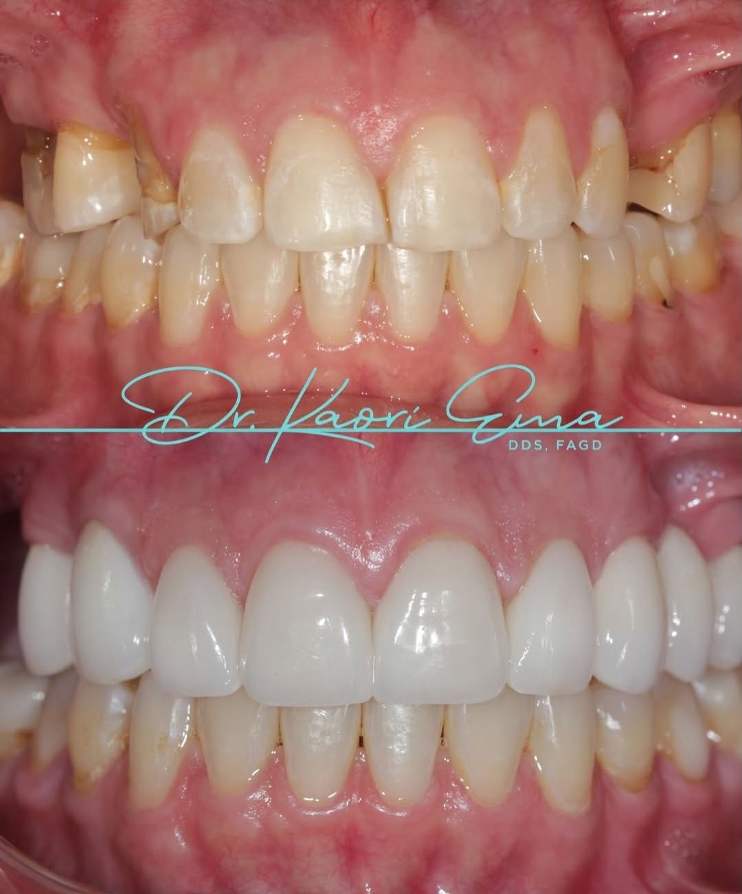 Instagram post by Dr. Kaori C. Ema: A beautiful smile makeover is about so much more than simply making teeth whiter. ✨ After completing orthodontic treatment, this patient was…