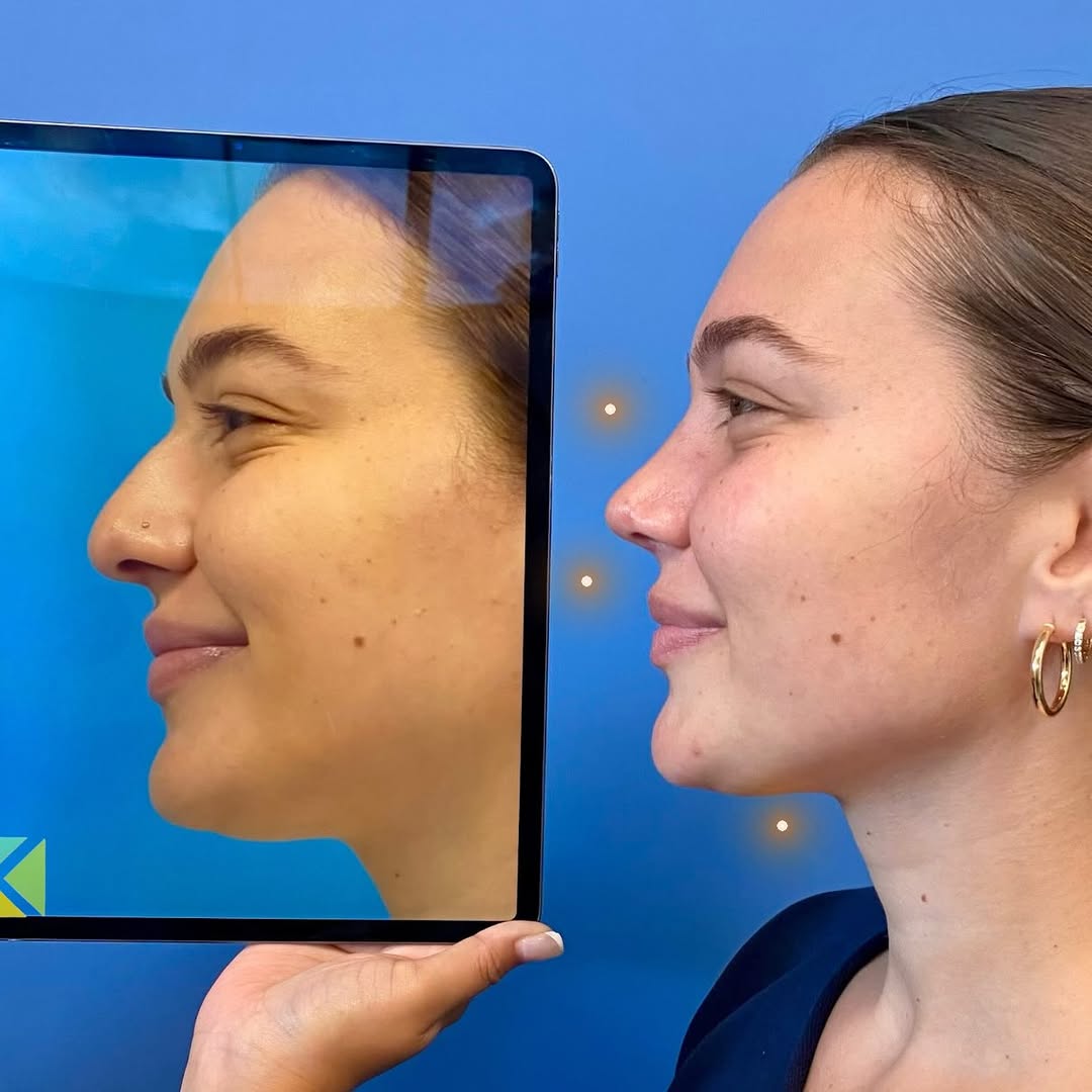 Instagram post by Dr. Kapil Saigal: 🤩 Our beautiful patient is looking absolutely amazing after an endonasal rhinoplasty and subtle chin liposuction with us only 6 weeks ago! …