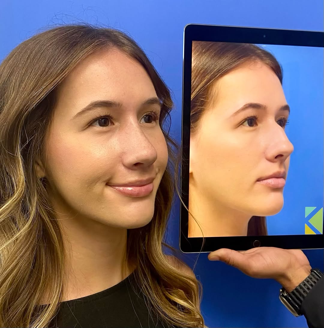 Instagram post by Dr. Kapil Saigal: Awesome!! Our beautiful patient from the East coast of FL is looking incredible🤯 only 2 weeks after endonasal rhinoplasty!! Thank you and y…