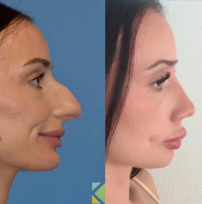 Instagram post by Dr. Kapil Saigal: WOW! 🤩 AMAZING, breathtaking update from our lovely patient after a game-changing surgery and she is looking fantastic!! She traveled from …