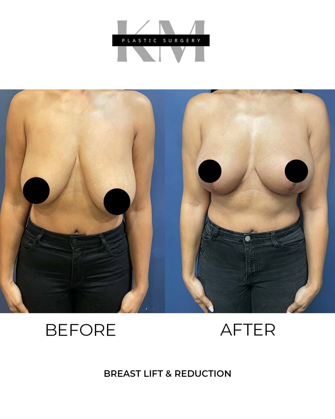 Instagram post by Dr. Karan Mehta: A breast reduction & lift is typically performed under general anesthesia to ensure patient comfort. During the surgery, Dr. Mehta will make…