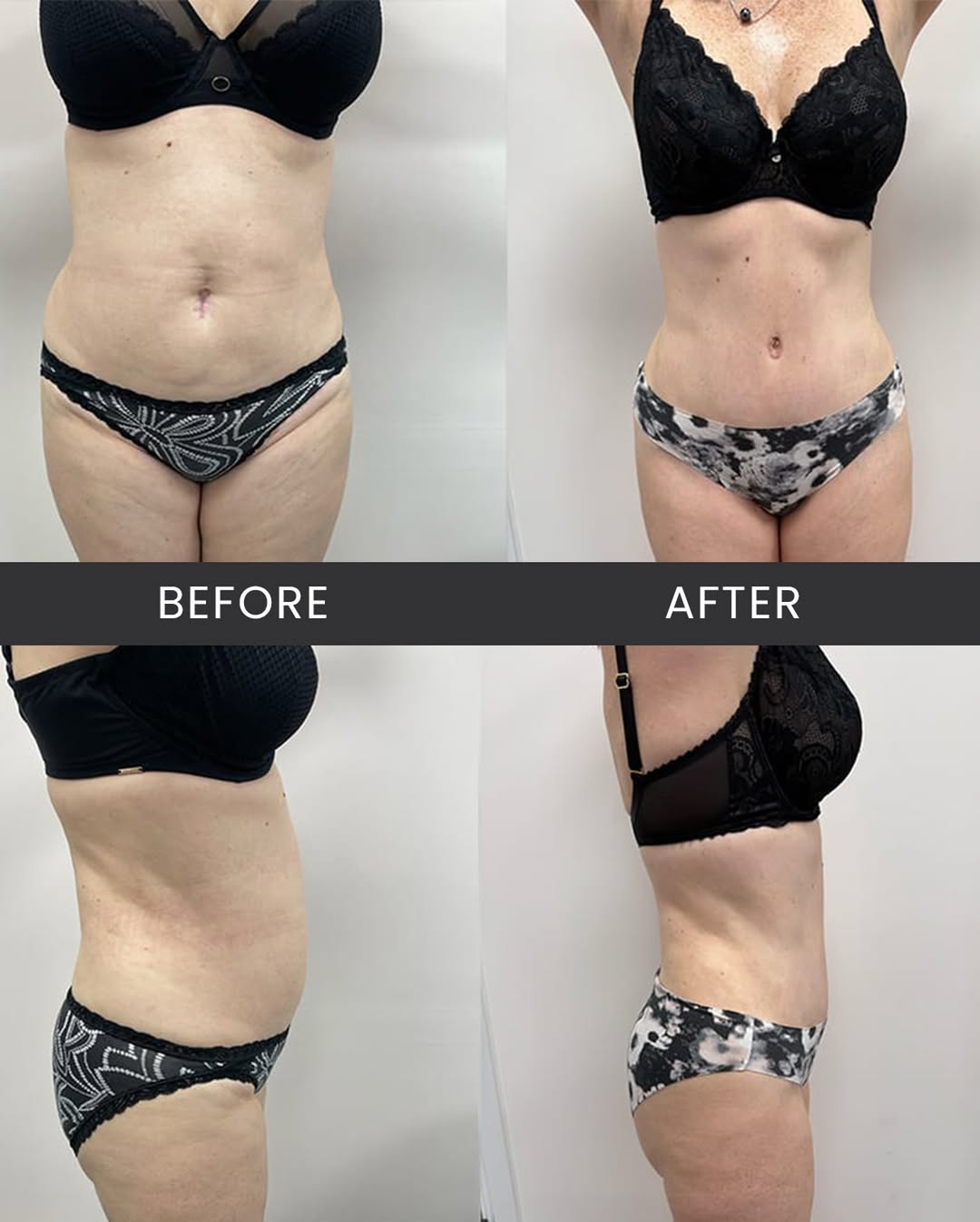 Instagram post by Dr. Karan Mehta: Having more children after a Tummy Tuck is possible, but it’s recommended to undergo a tummy tuck once you have completed your family. Pregn…