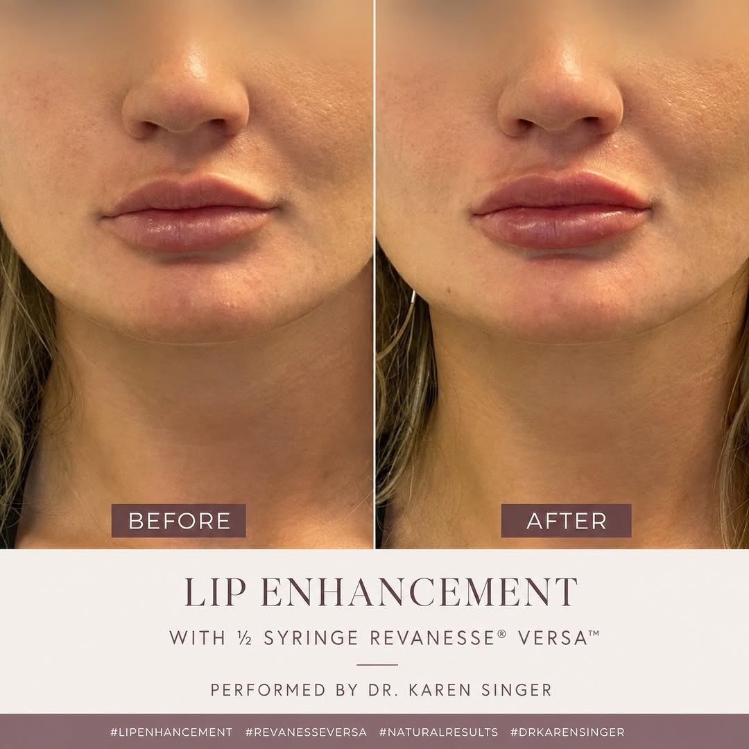 Instagram post by Dr. Karen Singer: ✨ Small enhancement. Beautifully natural results. ✨ This patient wanted a subtle refresh to her lips — just a little more definition, balanc…