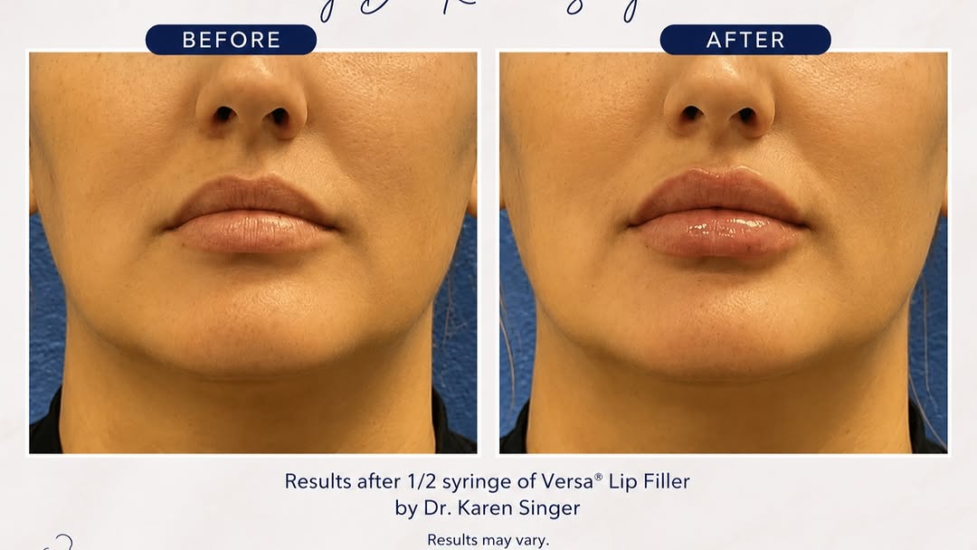 Instagram post by Dr. Karen Singer: 💋 A little enhancement can make a beautiful difference! This patient received ½ syringe of Versa® Lip Filler with Dr. Karen Singer to enhan…