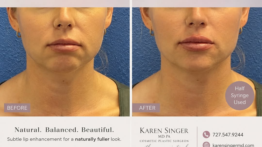 Instagram post by Dr. Karen Singer: Subtle Lip Enhancement 💋 A little can go a long way! ✨ For this beautiful lip enhancement, Dr. Karen Singer used just ½ syringe of Versa to…