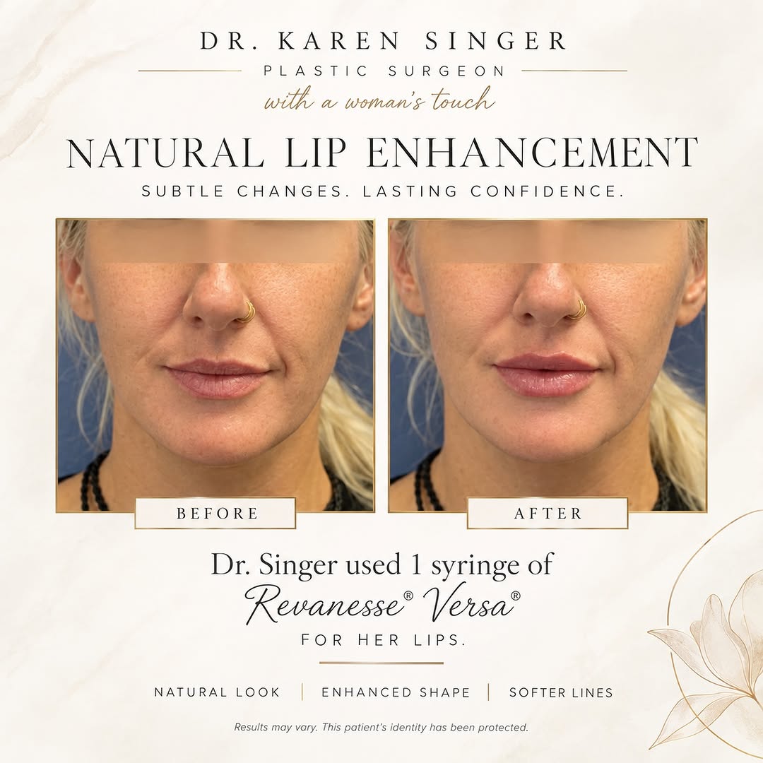 Instagram post by Dr. Karen Singer: 💋 Natural Lip Enhancement with Dr. Singer Sometimes, a little enhancement is all you need! ✨ For this patient, Dr. Singer used just 1 syrin…