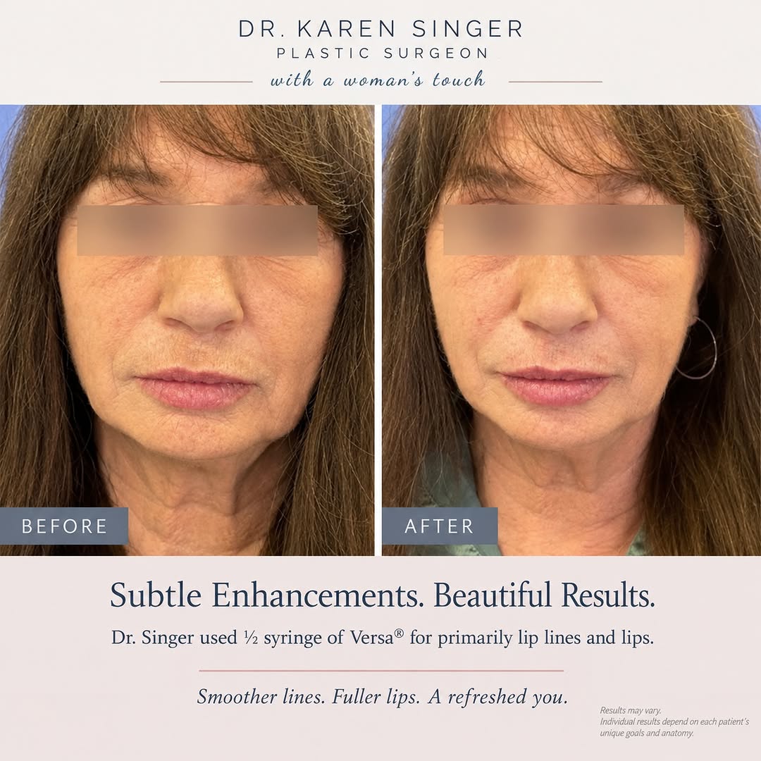 Instagram post by Dr. Karen Singer: Liplines ..... gone! This patient received **½ syringe of Revanesse Versa®**, used primarily to soften the appearance of lip lines while add…
