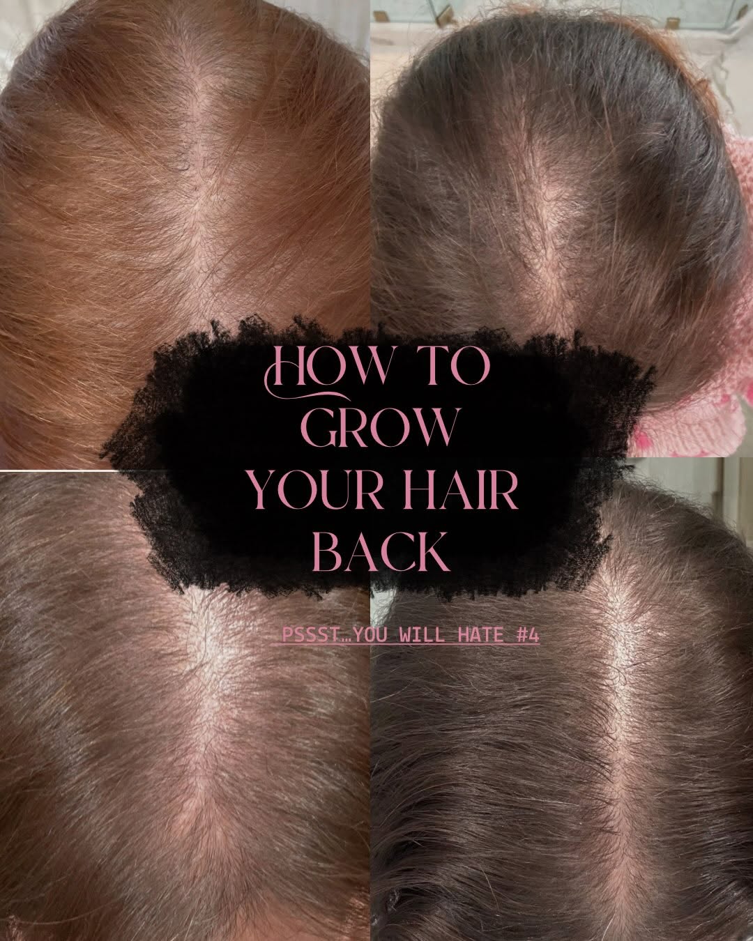 Instagram post by Dr. Karlee Heffner, N: How I grew my hair back 💗 Hair loss can have many causes, including hormones, thyroid issues, low iron, nutrition, stress, medications, gen…