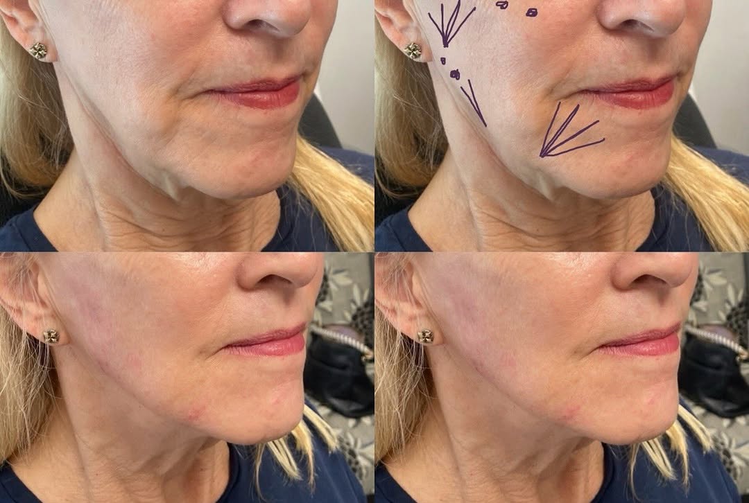 Instagram post by Dr. Karlee Heffner, N: ✨2 sessions later✨ First session: 1 hyperdilute Radiesse for collagen stimulation to lower face. 1 syringe Cheek filler for instant gratific…