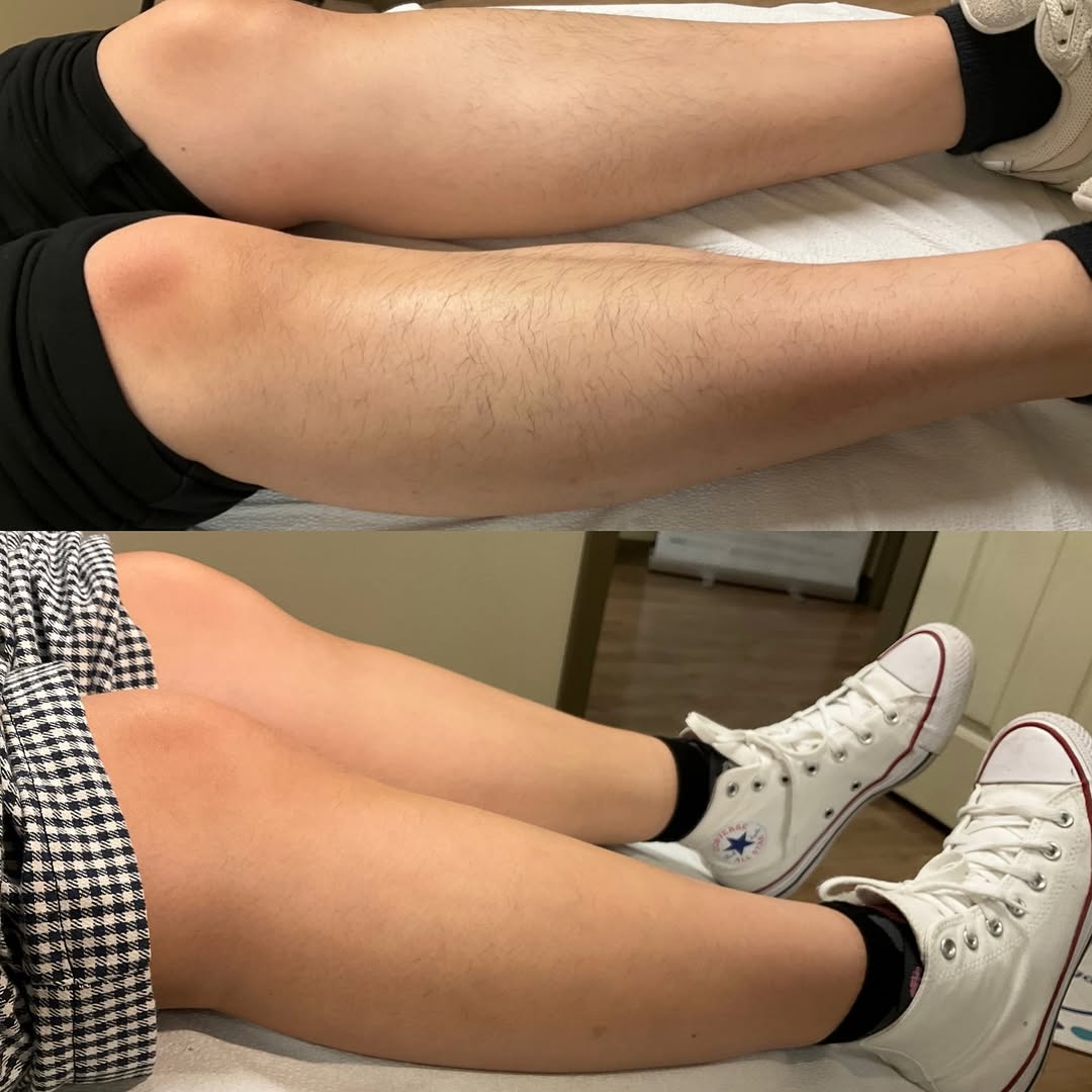 Instagram post by Dr. Katarzyna Tesmer: ✨ Smooth skin, fewer worries ✨ Swipe to see the difference! ➡️ After just 2 laser hair removal treatments, our client is already seeing thin…