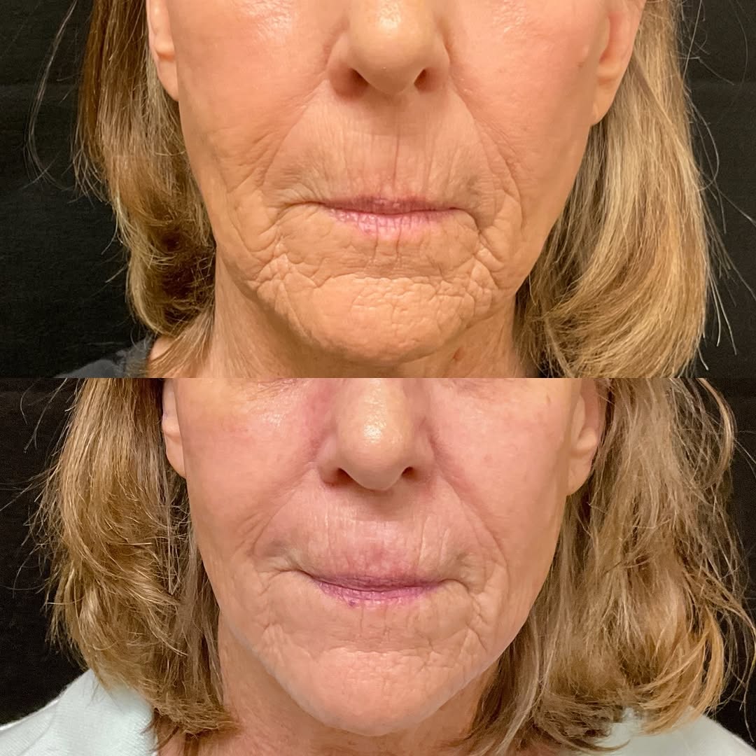 Instagram post by Dr. Katarzyna Tesmer: Lower Face Rejuvenation with Redensity ✨ Subtle changes, beautiful results. Redensity filler restored hydration and support to the lower fac…