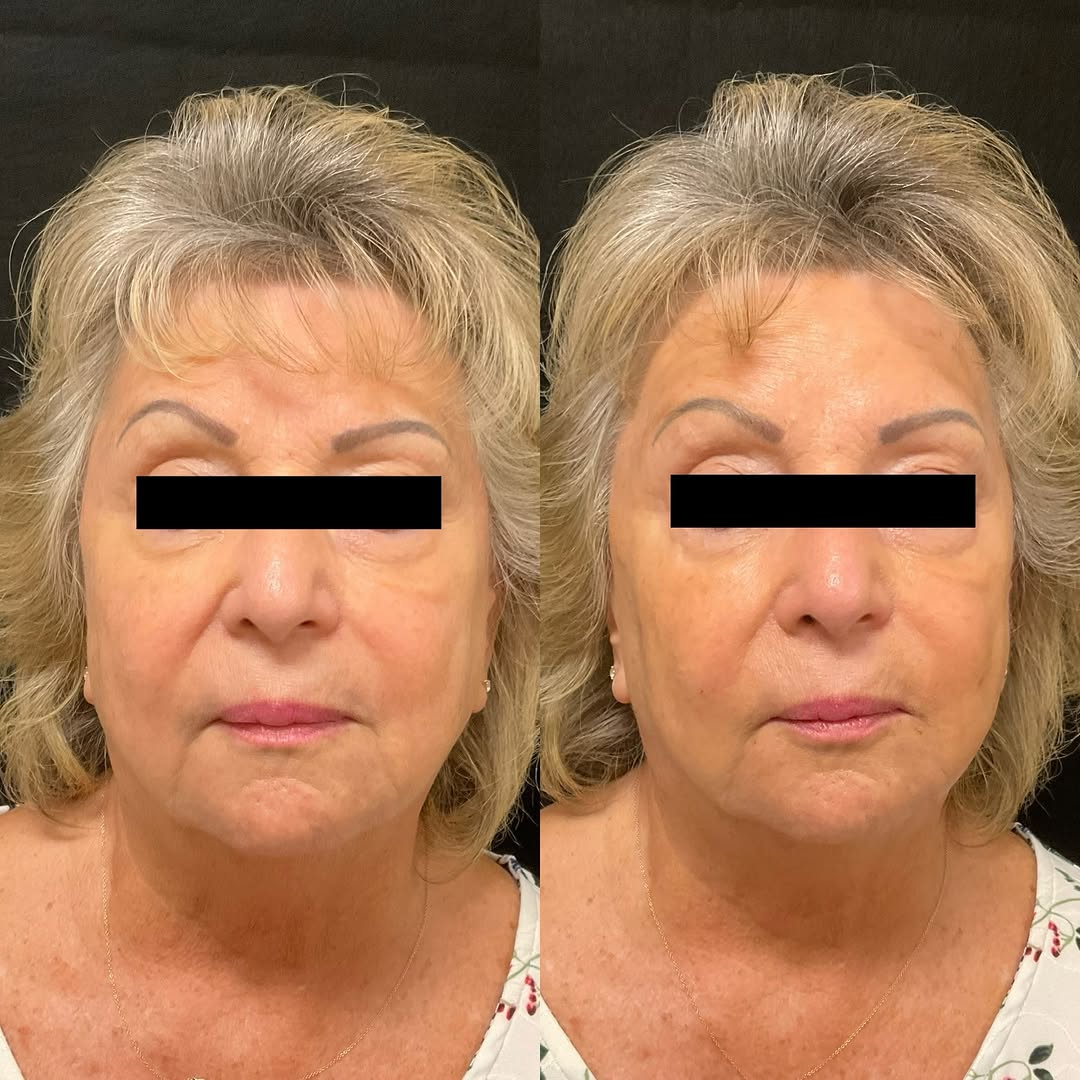 Instagram post by Dr. Katarzyna Tesmer: Before & After ✨ RHA4 dermal filler 💉 Subtle correction of the nasolabial folds and marionette lines, restoring volume and creating a smoot…
