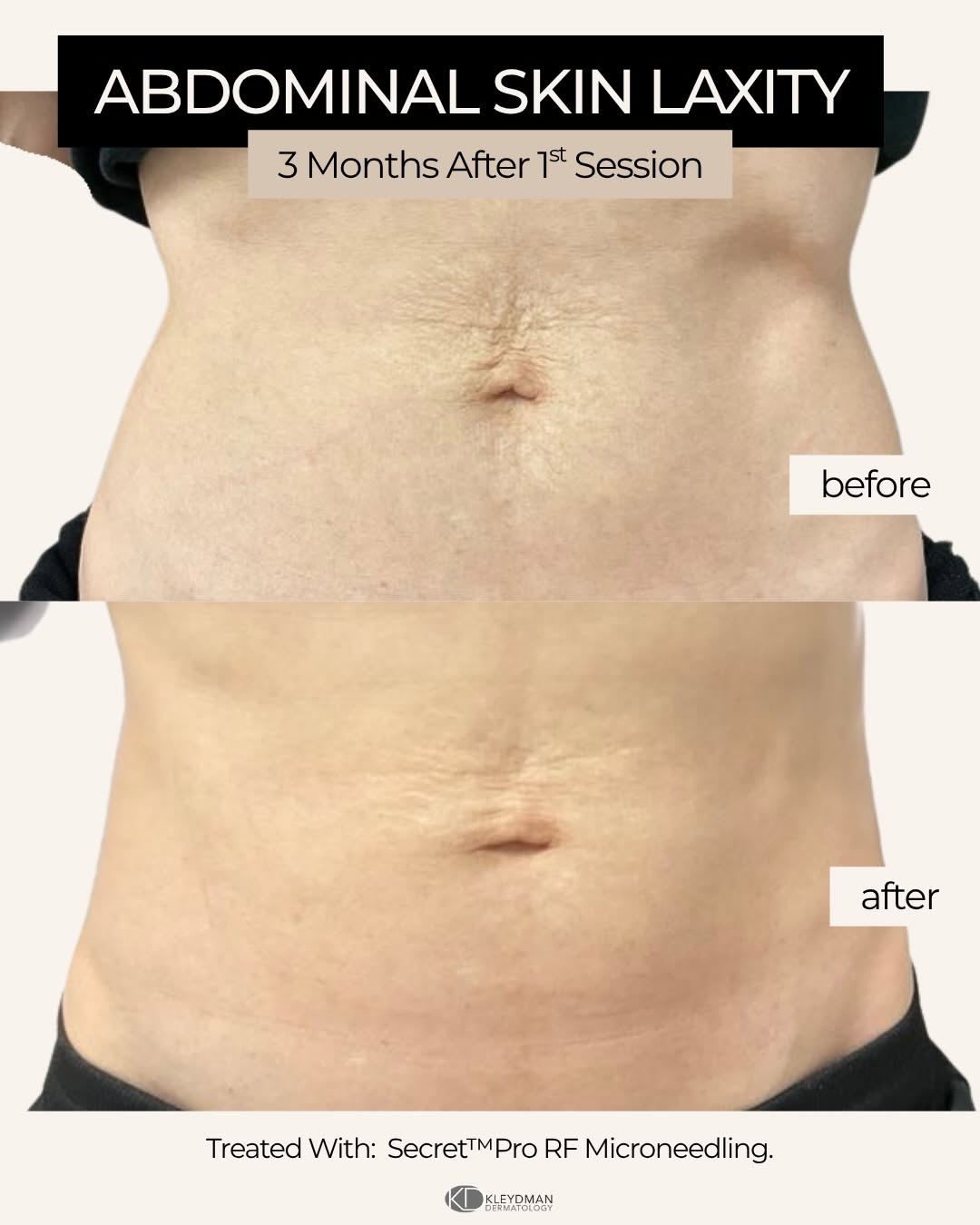 Instagram post by Dr. Kate Kleydman: One session. Three months of collagen remodeling. RF microneedling isn’t just for the face— it’s also great for areas like the abdomen, neck…