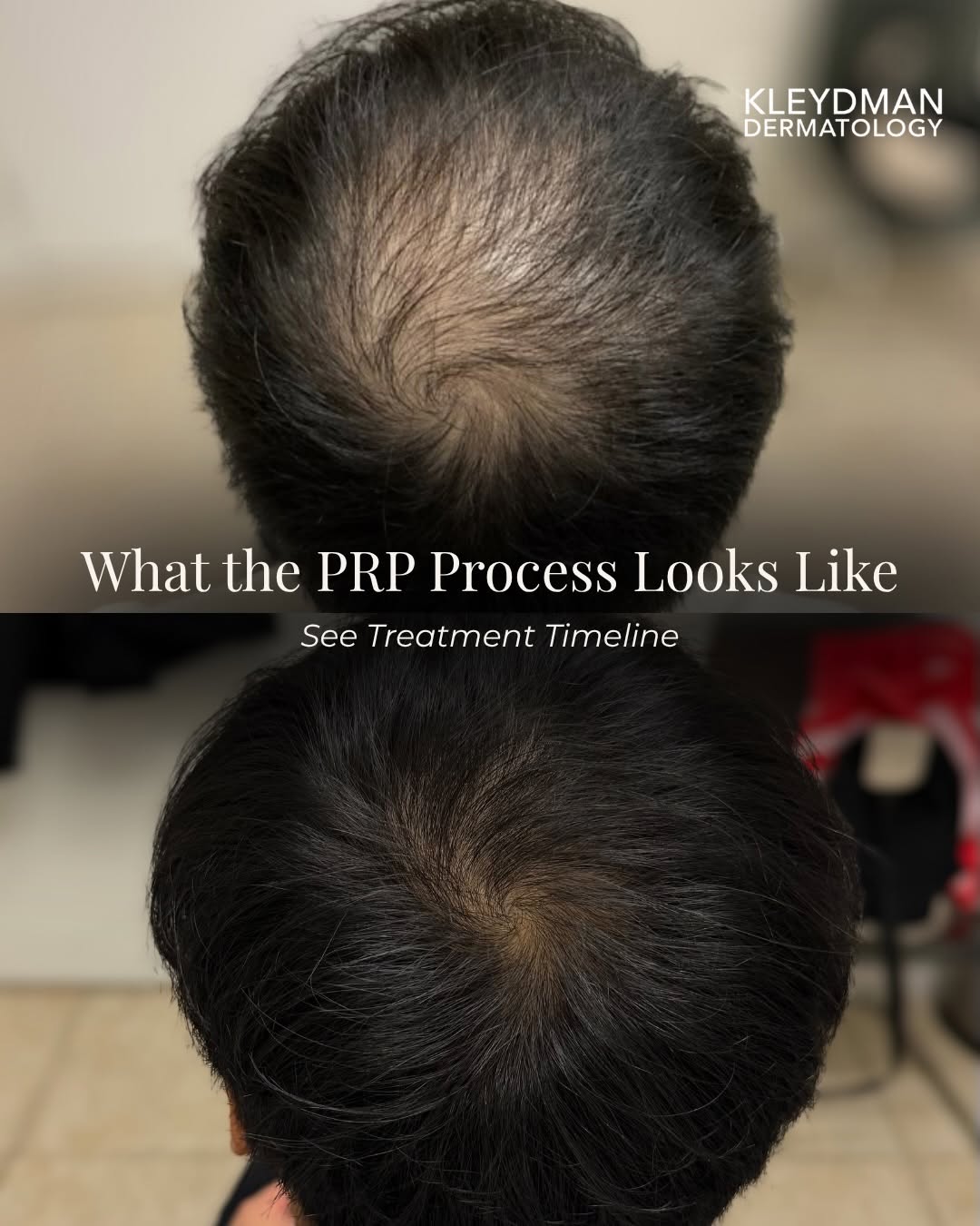 Instagram post by Dr. Kate Kleydman: PRP for hair loss is a process, not a one time treatment. This progress is a great example of why staying consistent matters. #hairloss #prp…