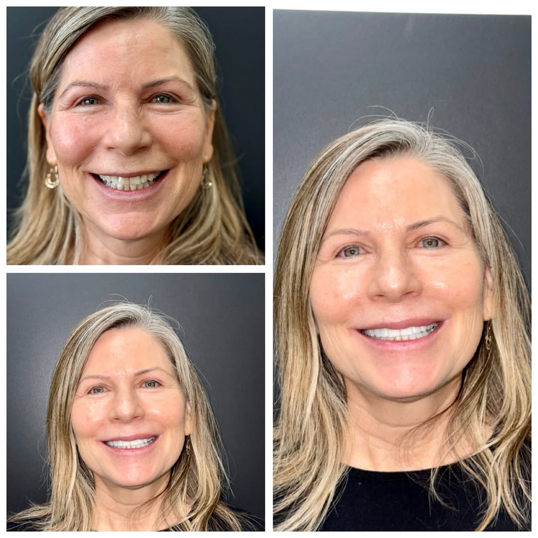 Instagram post by Dr. Kate Sahafi: This transformation was done with cosmetic bonding to improve shape, symmetry, and brightness while preserving natural tooth structure. Subtā¦