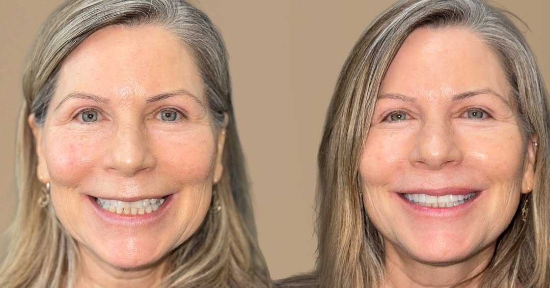 Instagram post by Dr. Kate Sahafi: One-visit smile upgrade ⨠This transformation was completed with bonding on 8 front teethāno drilling, no veneers, and no waiting weeks for ā¦