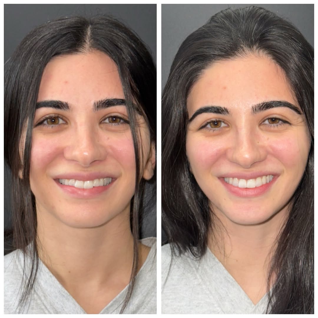 Instagram post by Dr. Kate Sahafi: Proud mom moment. Conservative composite bonding on my daughterās front teeth refined shape, closed small spaces, and brightened her smileāwā¦