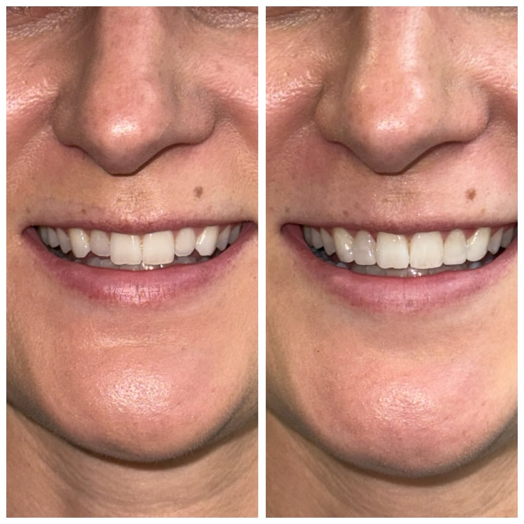 Instagram post by Dr. Kate Sahafi: Itās amazing what we can achieve in just one visit. This patient wanted to refresh her smile, and cosmetic bonding was the perfect, conservaā¦