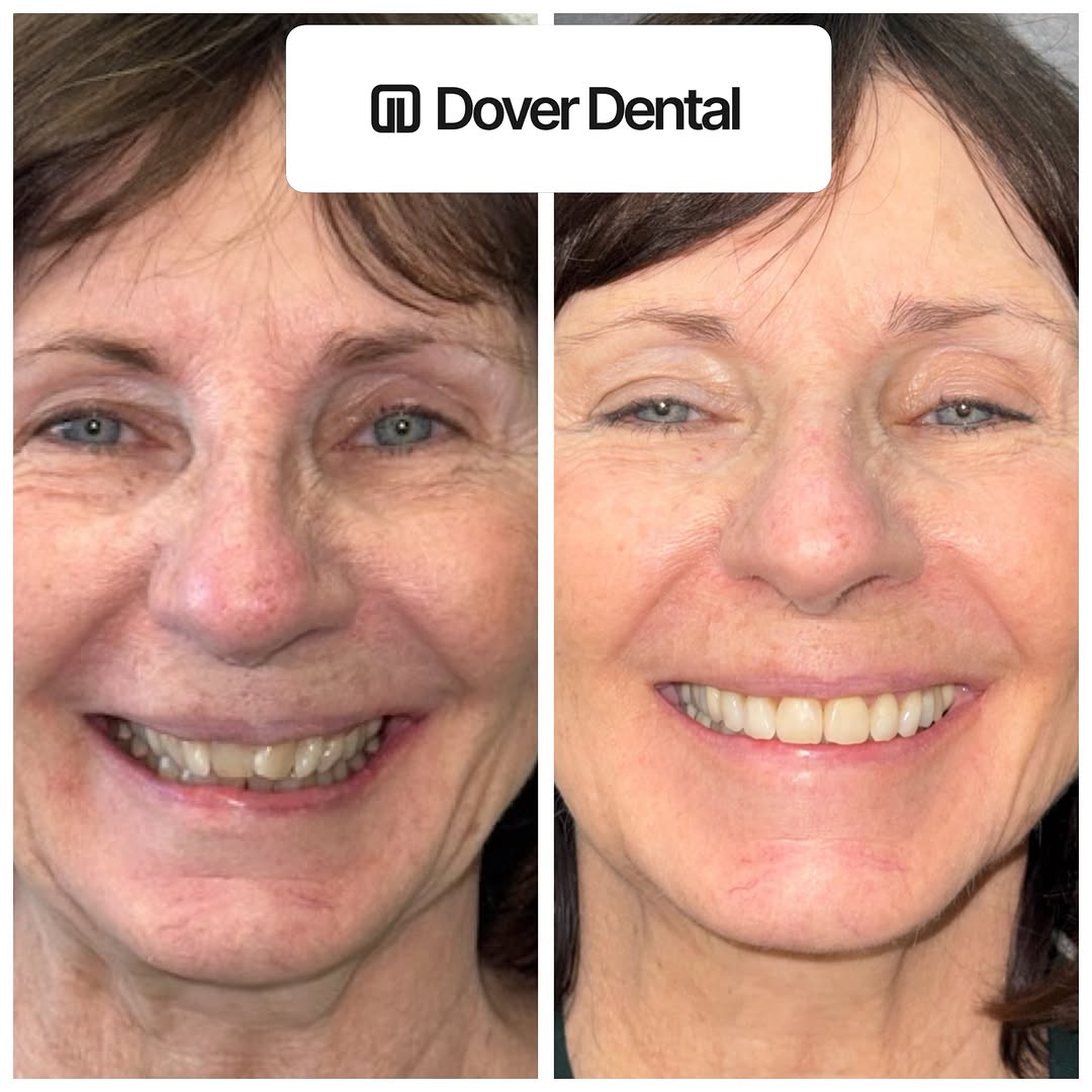 Instagram post by Dr. Kate Sahafi: From subtle shifts to a total transformation! ⨠We used a three-step approach to achieve this beautiful, radiant smile: 1ļøā£ Invisalign to peā¦