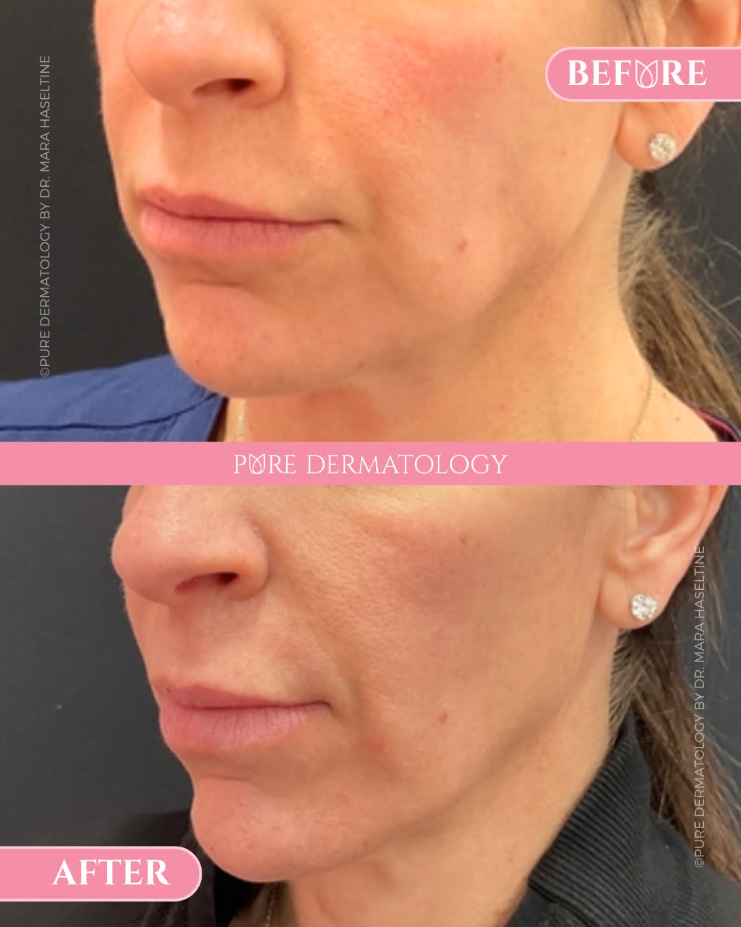 Instagram post by Dr. Kate Zibilich Holcomb: Subtle changes. Beautiful results. As we age, it's natural to lose facial volume and collagen. Over time, that can make the jawline appear s…