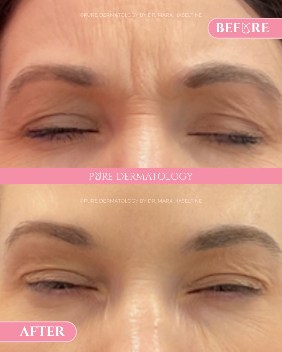 Instagram post by Dr. Kate Zibilich Holcomb: Those "11s" don't have to be permanent. Glabellar lines, often called the "11 lines," are the vertical lines that form between your eyebrows…