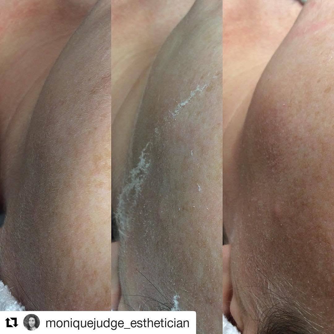 Instagram post by Dr. Kathleen W. Judge: #Repost @moniquejudge_esthetician (@get_repost) ・・・ Ahhh the difference a dermaplaning can make! Gently exfoliating by dermaplaning removes …