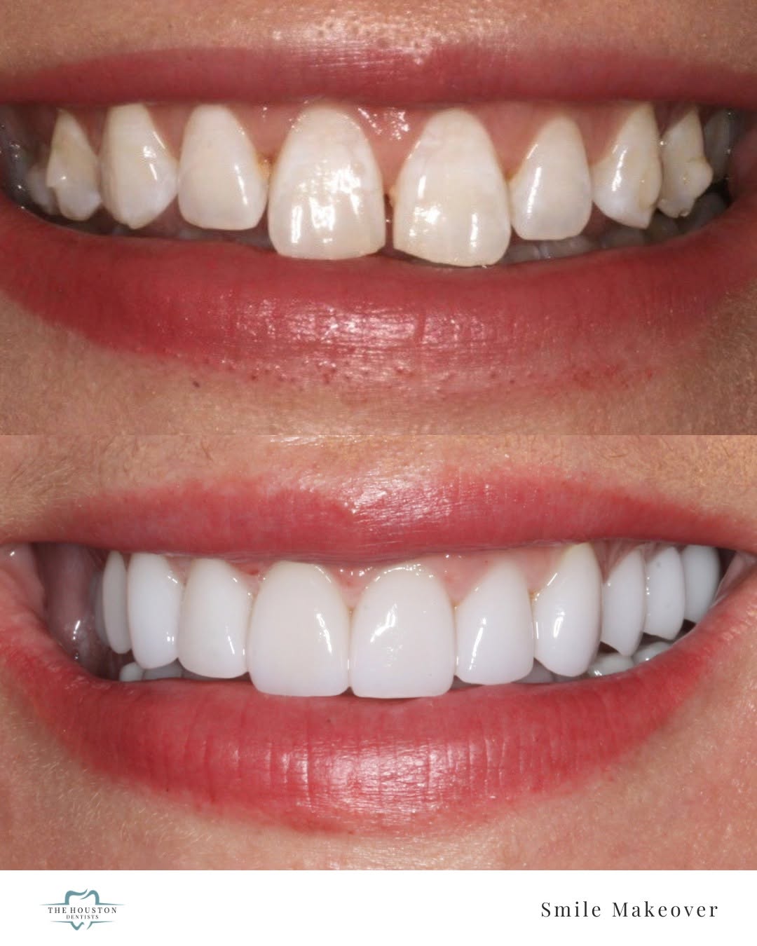 Instagram post by Dr. Kathy Frazar: Uneven and inconsistent. Then this. ✨ Custom porcelain veneers designed to look like the smile that was always supposed to be there. The con…